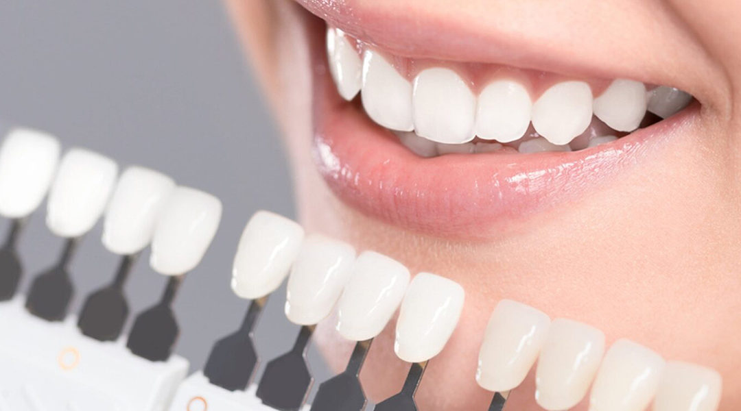 How Can Veneers Help You Improve Your Smile?