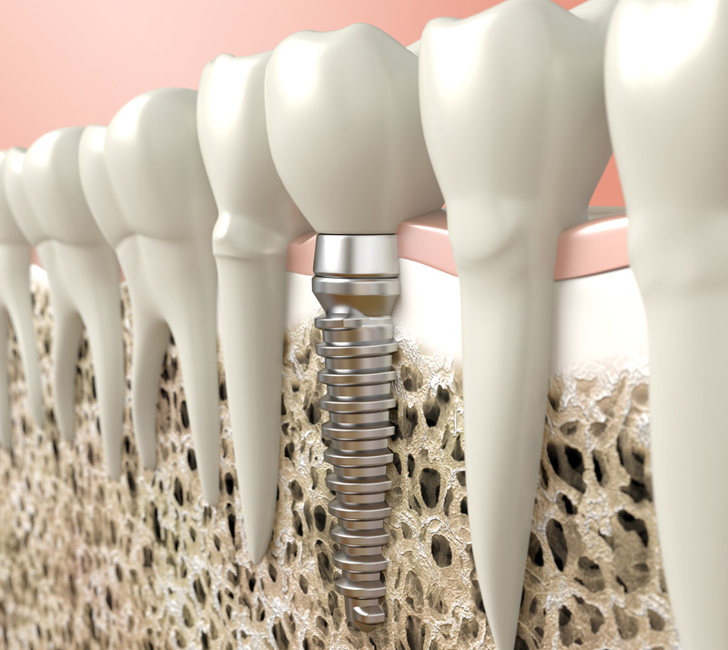 restorative dental implants in downtown calgary