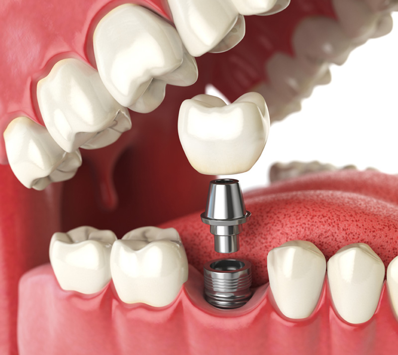 restorative dental implants near you