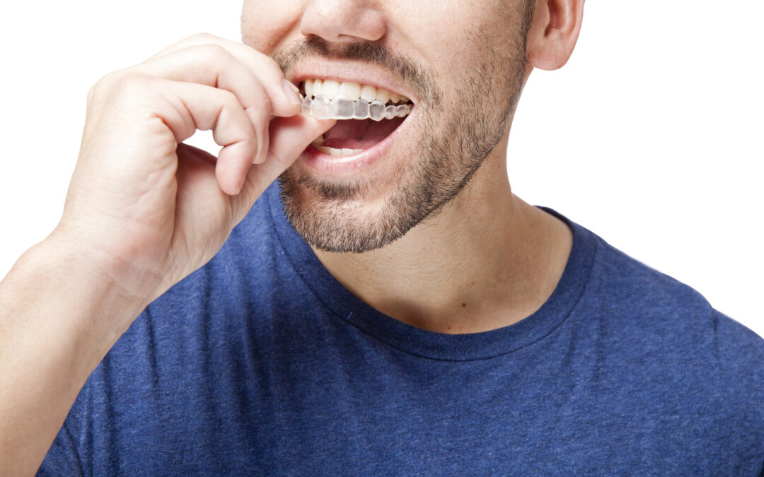 Everything You Should Know About Invisalign